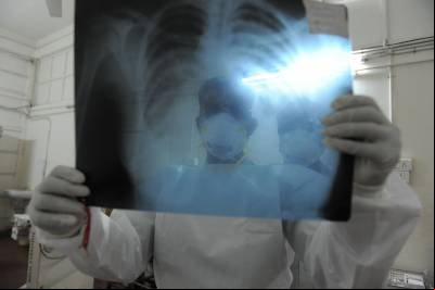 O que é H1N1 e como evolui para broncopneumonia, causa da morte de Silvio Santos